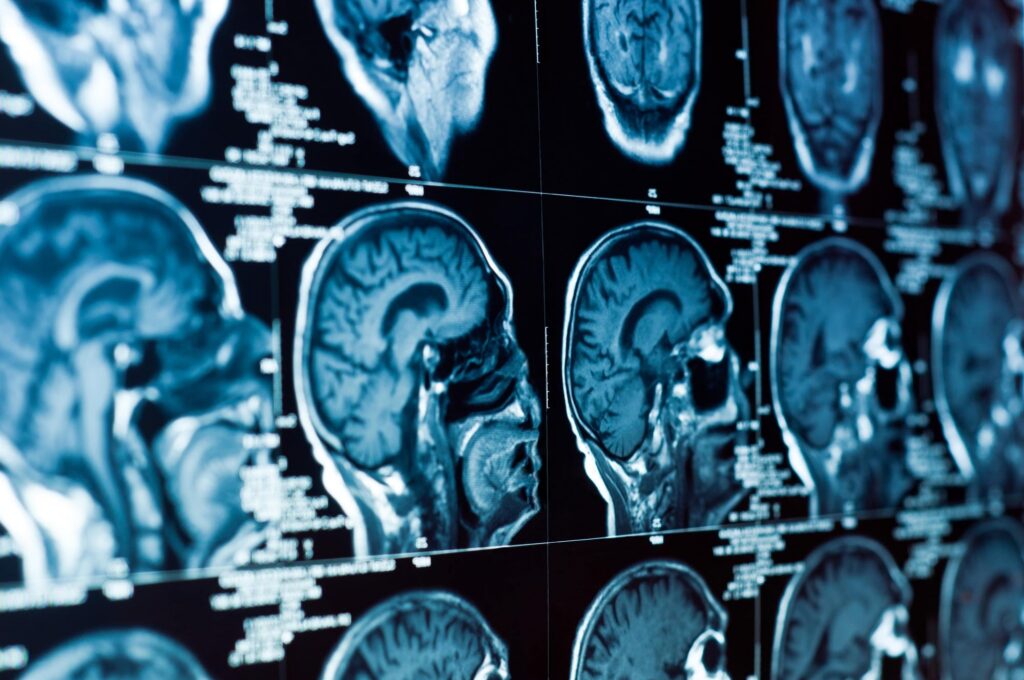 brain injury lawyer