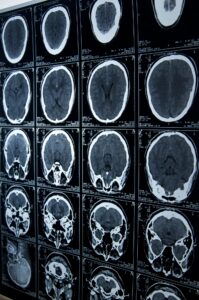 brain injury lawyer in White Rock, CA